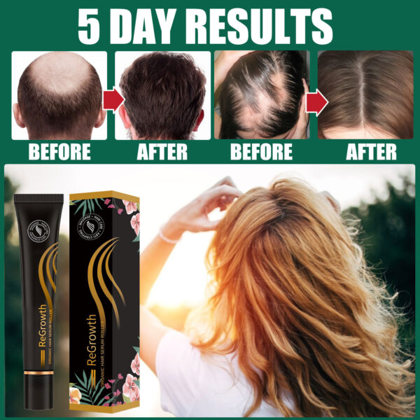 Regrowth Organic Hair Serum Roller Set Hair Care Anti Stripping Liquid Suitable For All Types Of Hair Loss Scalp Nourishing - Image 4